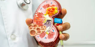 صورة توضيحية للفشل الكلوي